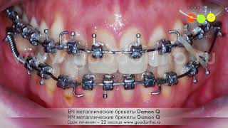 Сложное лечение на металлических брекетах Damon Q