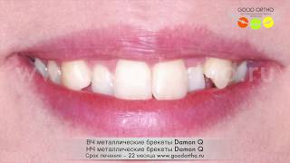 Опустить клык в зубной ряд на внутренних лингвальных брекетах