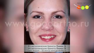 Улыбка, созданная металлическими брекетами Damon Q за 22 месяца.