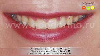 Достаем из кости клык брекетами Damon Q