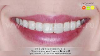 Лечение комбинированной брекет-системой: лингвальные + обычные металлические брекеты.