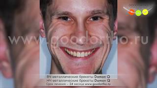 Улыбка создана брекетами Damon за 24 месяца.
