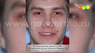 Пример расширения улыбки с помощью внутренних брекетов.