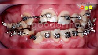 Как закрыть открытый прикус брекетами?