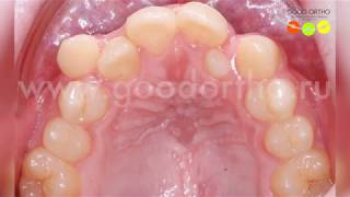 Можно ли эффективно выравнивать зубы БЕЗ удаления?