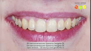 Работа индивидуальных цифровых брекетов Insignia