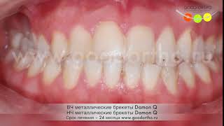 Коррекция перекрестного прикуса на фоне сужения ВЧ металлическими брекетами Damon Q