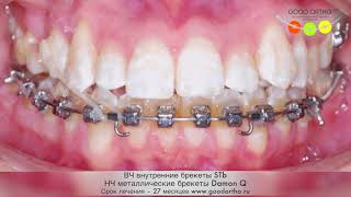История дружбы лигвальных и вестибулярных брекетов