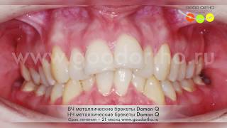 Исправление прикуса на брекетах Damon Q