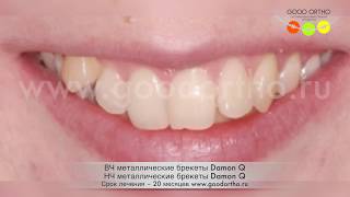 Постановка дистопированного правого клыка в зубной ряд.