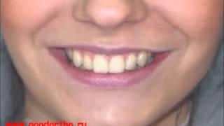 Брекеты ДО и ПОСЛЕ. Клиники GoodOrtho - мастерская вашей улыбки.