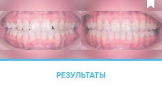 Лечение скученности без удаления при помощи кап-элайнеров