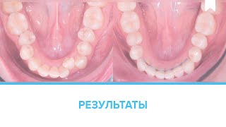 Лечение скученности без удаления системой элайнеров на обеих челюстях