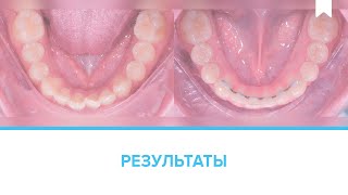 Лечение скученности без удаления съемными капами-элайнерами