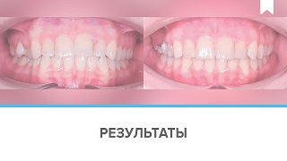 Лечение капами-элайнерами скученности зубов без удаления за 13 месяцев