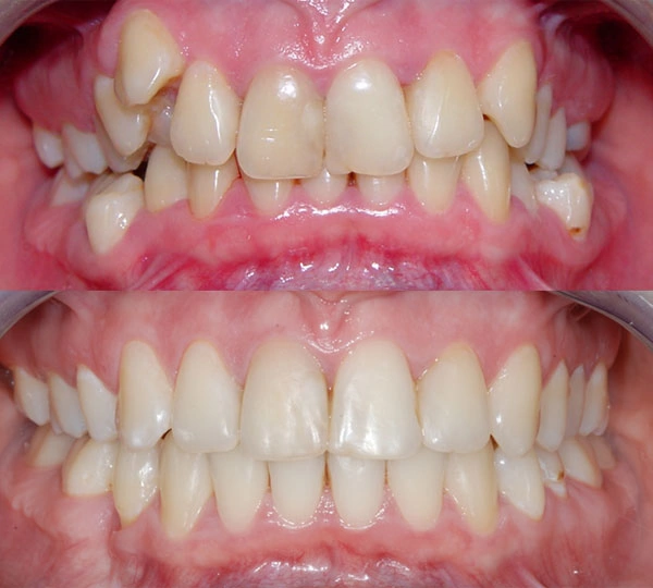 До и после лечения с удалением трех зубов