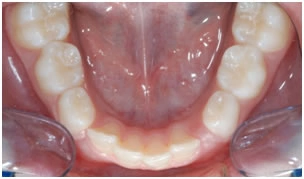 Раннее лечение детей частичной брекет-системой