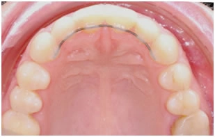 Промежутки (тремы) между передними зубами одной из челюстей