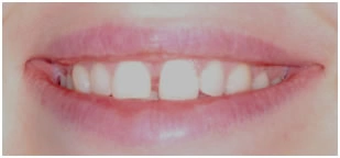 Промежутки (тремы) между передними зубами одной из челюстей