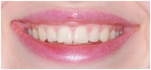 Промежутки (тремы) между передними зубами одной из челюстей
