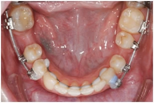 Закрытие промежутков от ранее удаленных зубов