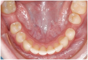 Закрытие промежутков от ранее удаленных зубов