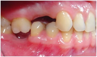 Пример внедрения правого верхнего шестого зуба для возможности протезирования