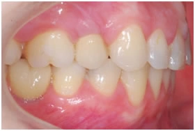 Пример внедрения правого верхнего шестого зуба для возможности протезирования