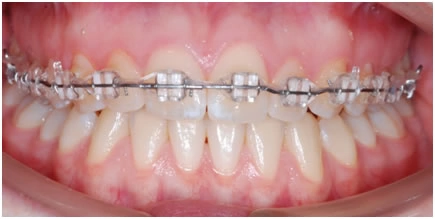 Лечение брекет-системой только на верхней челюсти, сапфировые брекеты. 
