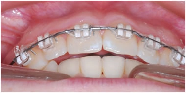 Выравнивание зубов за счет протрузии
