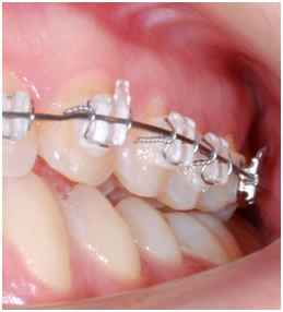 Выравнивание зубов за счет расширения зубного ряда