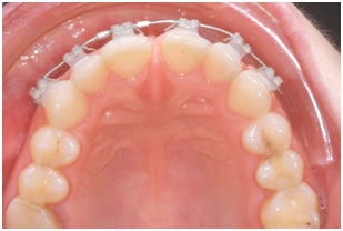 Промежутки (тремы) между передними зубами одной из челюстей