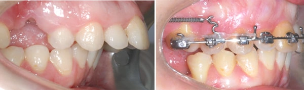 Пример коррекции дистального прикуса с удалением на верхней челюсти и смещением верхних передних зубов назад