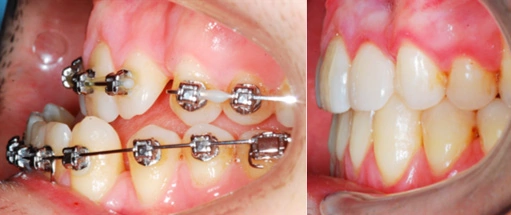 фото челюсти до и после операции