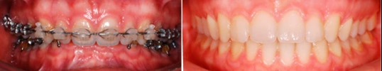 фото челюсти пациента до и после операции