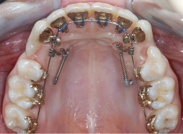 временные ортодонтические микроимпланты 