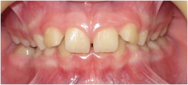 Ортодонтические пластинки глубокий прикус у ребенка