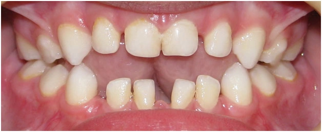 Ортодонтические пластинки открытый прикус у ребенка