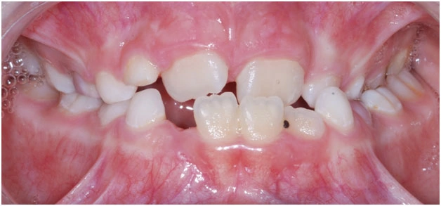 Ортодонтические пластинки перекрестный прикус у ребенка