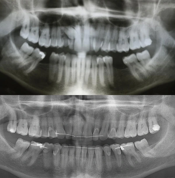 Пример перемещения седьмых и восьмых зубов на место ранее удаленных шестых на нижней челюсти у взрослой пациентки