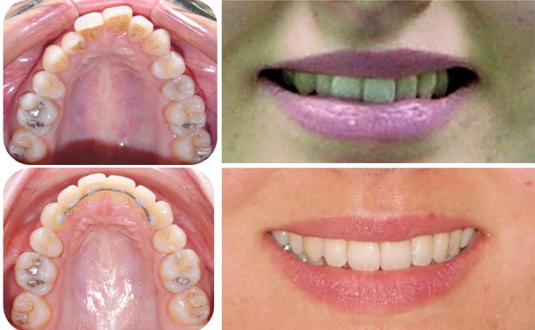 Пример смещения верхней средней линии из-за давнего удаления четвертого зуба справа