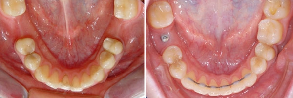 пример закрытия промежутка от ранее удаленного шестого зуба